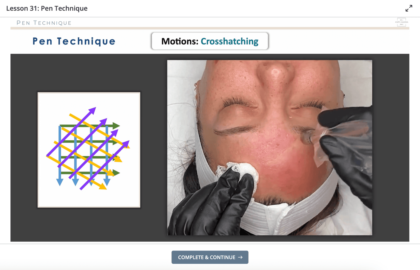 Microneedling Crosshatching Pen Technique