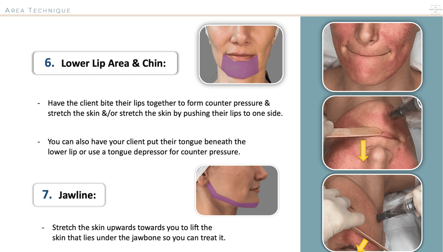 Microneedling techniques for different facial areas