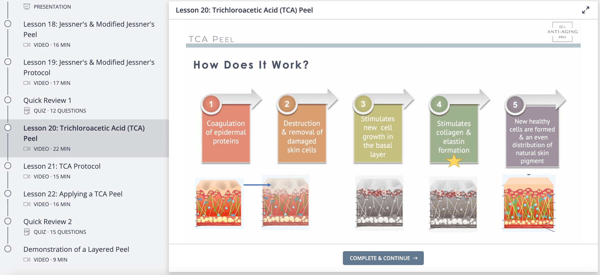 How does a TCA Peel work? Steps of wound healing cascade.  New collagen formation is the result