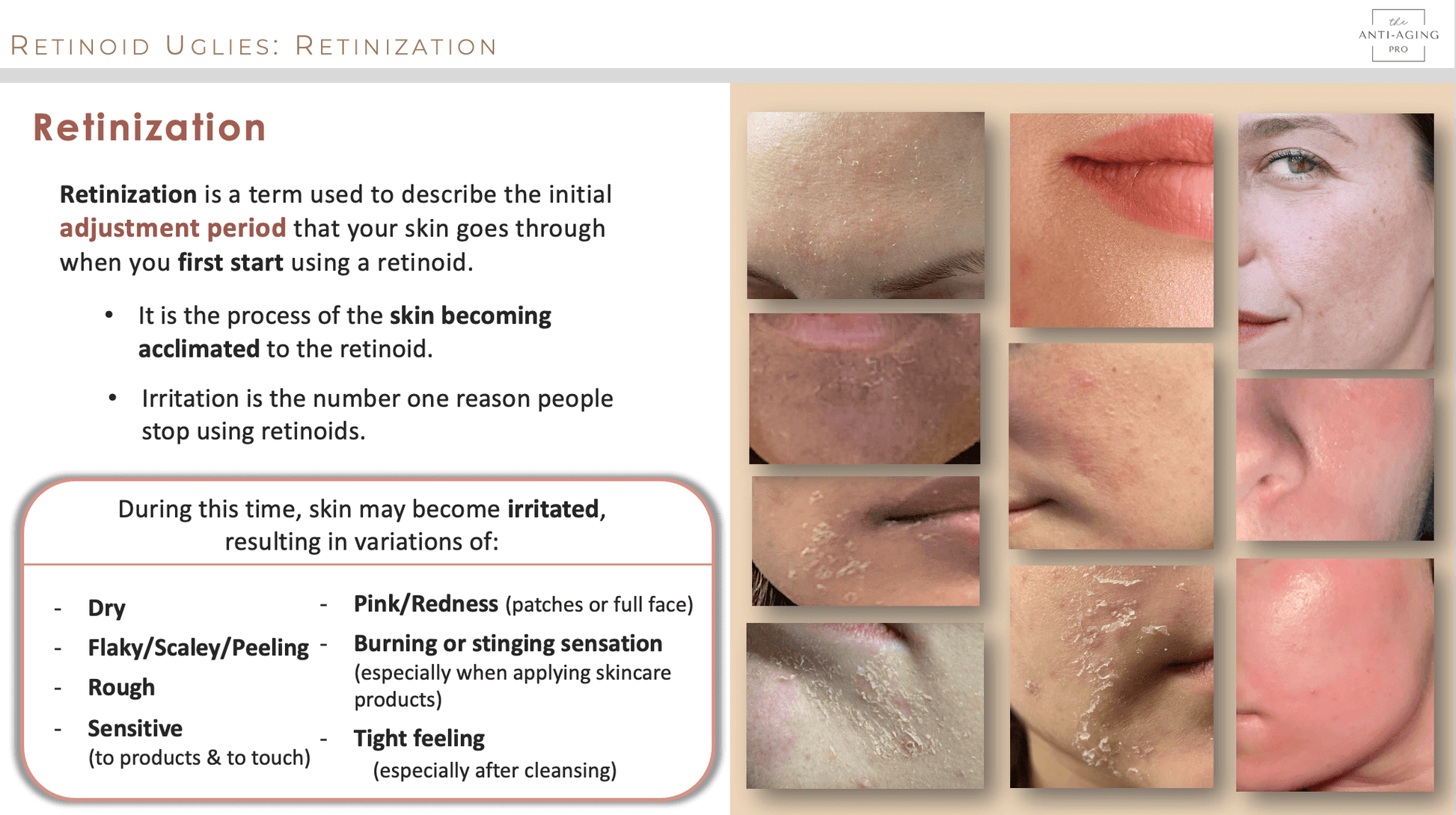 What is retinization? What are retinol uglies? The adjustment period when first starting retinoids.