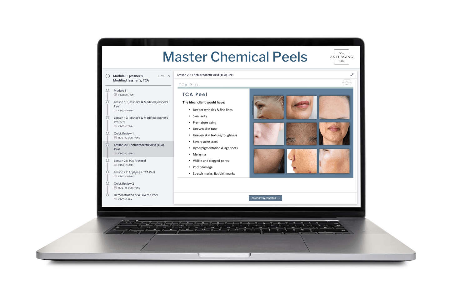 Master Chemical Peel Course TCA Lesson on a laptop