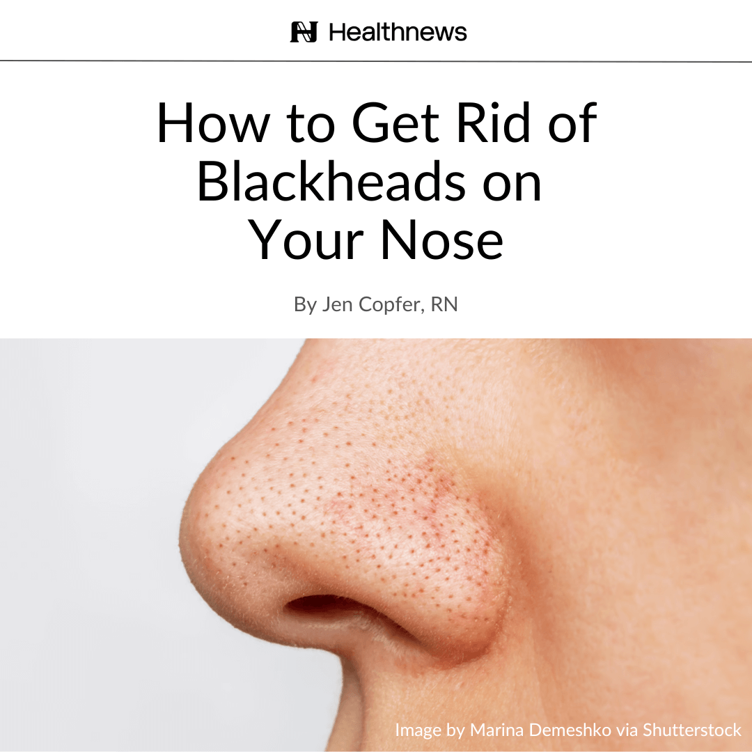 Image of blackheads on a nose