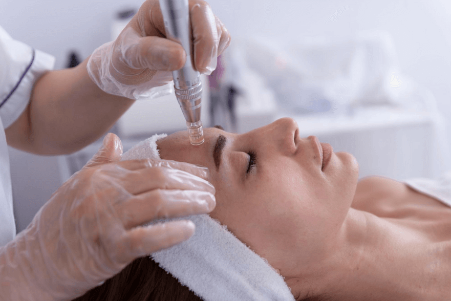 Woman receiving a microneedling facial treatment with a device held by a gloved hand.