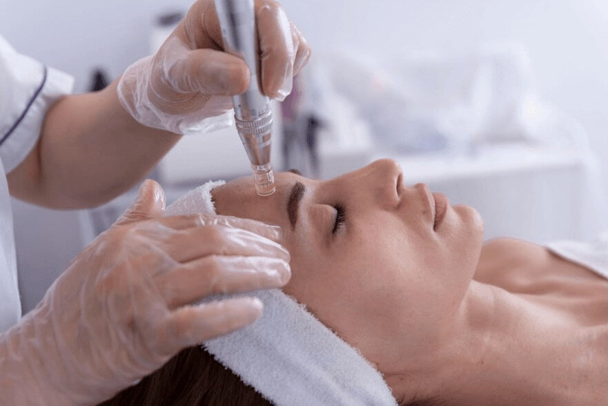 Woman receiving a facial treatment with a microneedling device