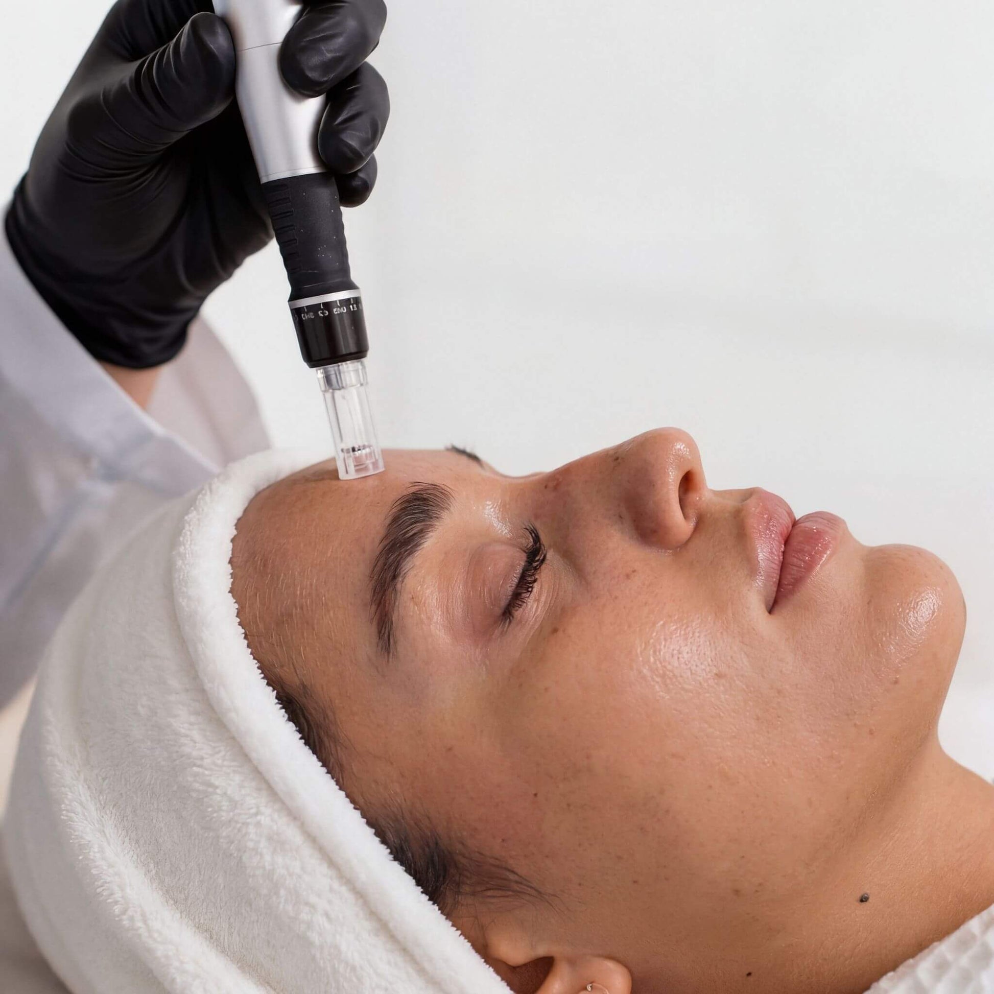 Women getting microneedling treatment