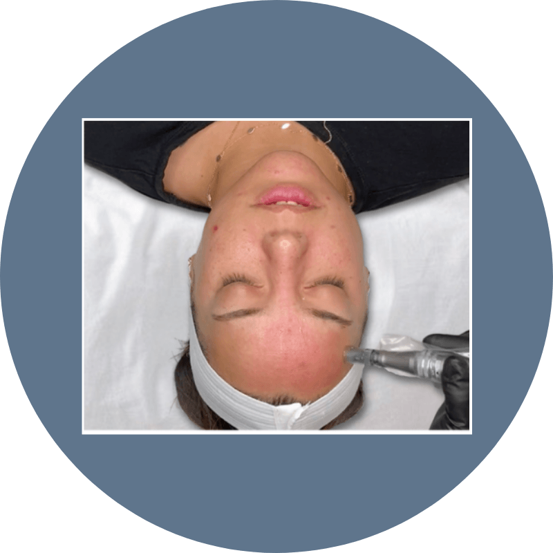 A woman receiving a microneedling treatment