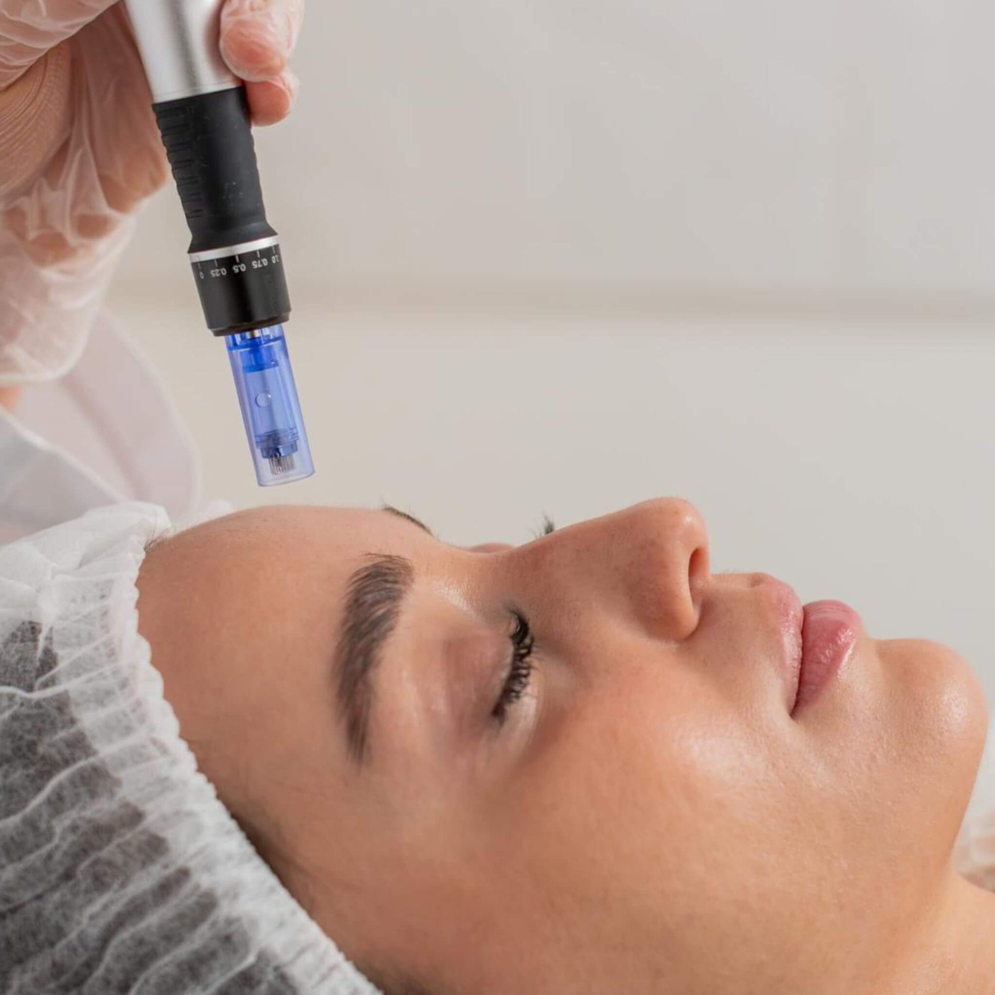 Women getting microneedling treatment